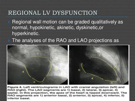 lv gram left ventriculogram|left ventricular angiogram normal range.